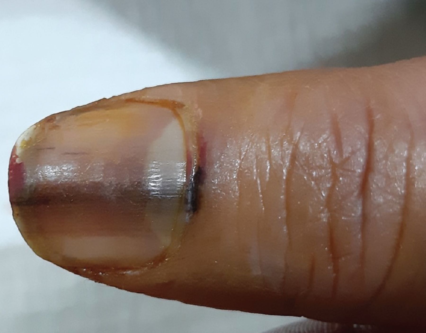 Hutchinson's sign in subungual melanoma