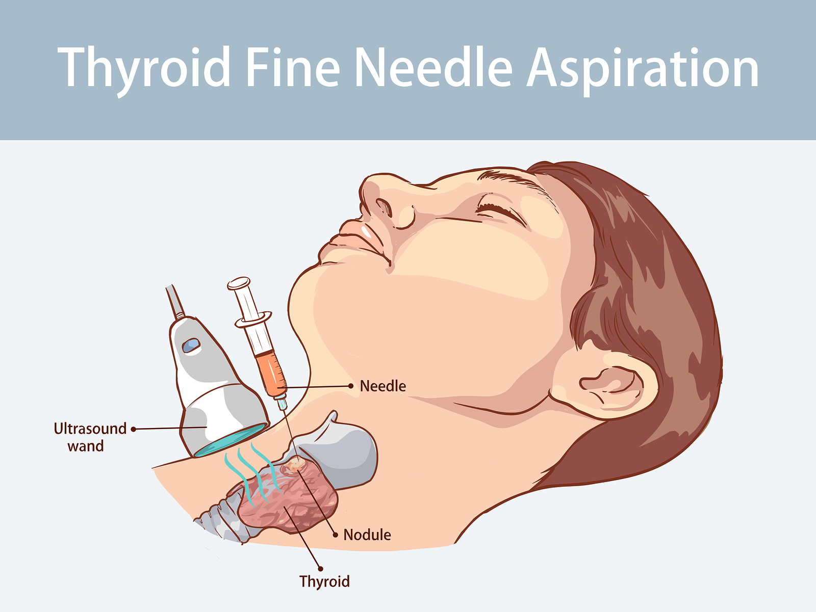 Thyroid FNAC under ultrasound guidance