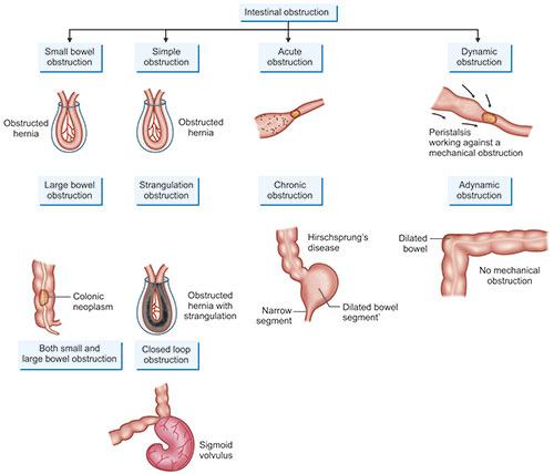 Patho Intestinal Obstruction Intestinal Obstruction | Gastrointestinal Pathology - OnCourse NEET-PG