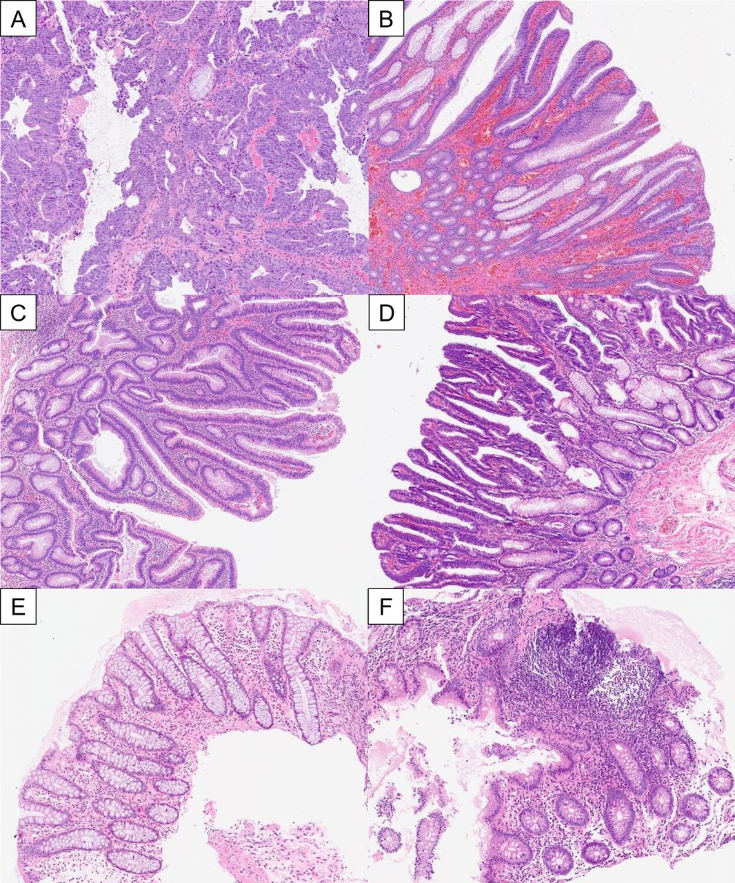 Histology of Villous Adenoma