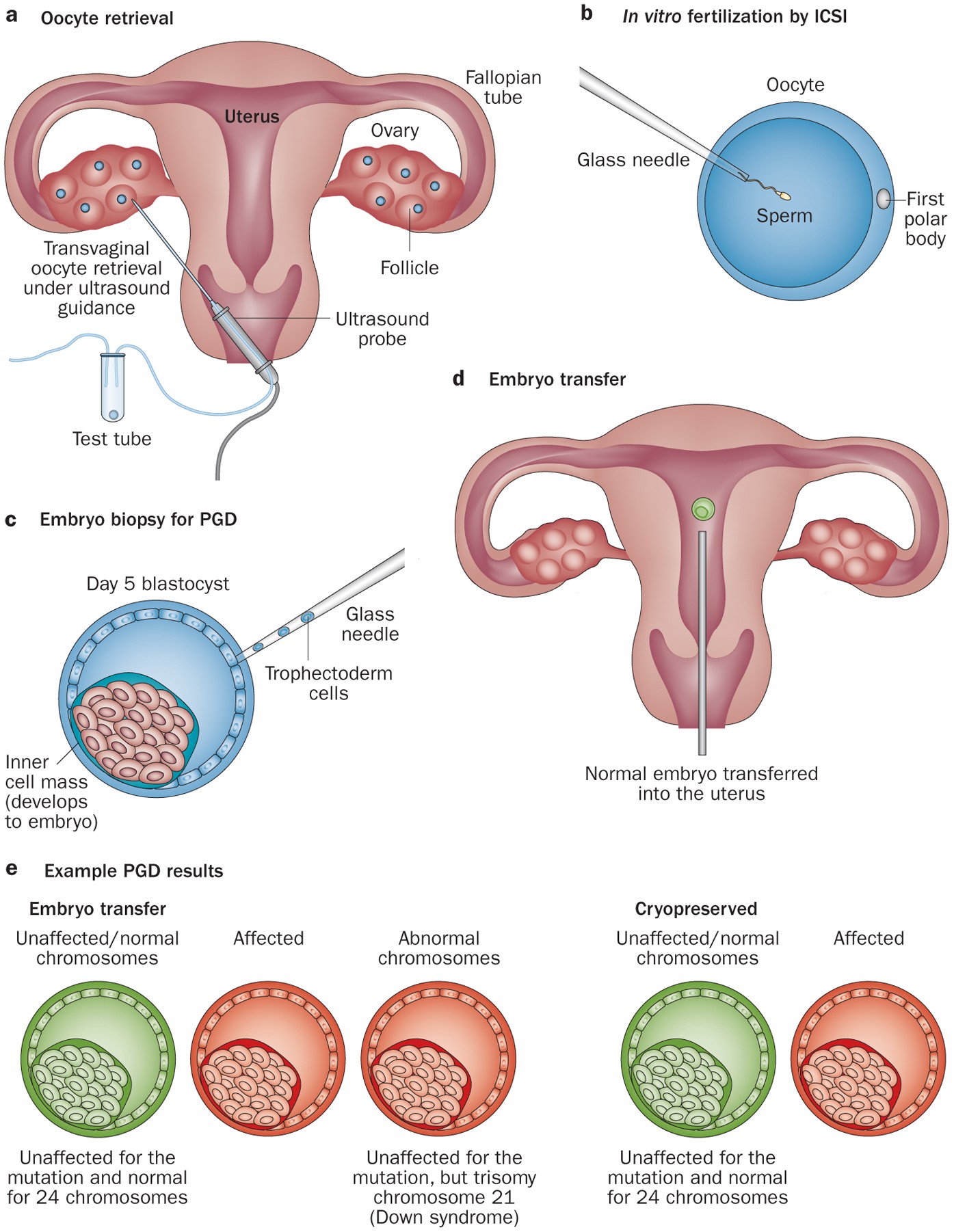 In Vitro Fertilization (IVF) and PGD process