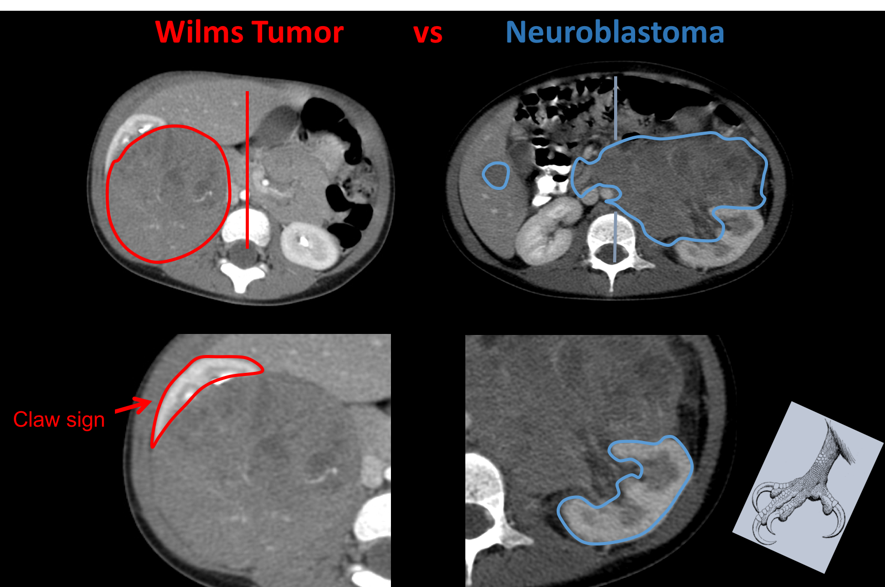 Comparative CT scans of Wilms tumor and Neuroblastoma