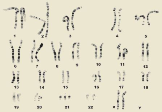 Karyotype showing Trisomy 21 (Down Syndrome)