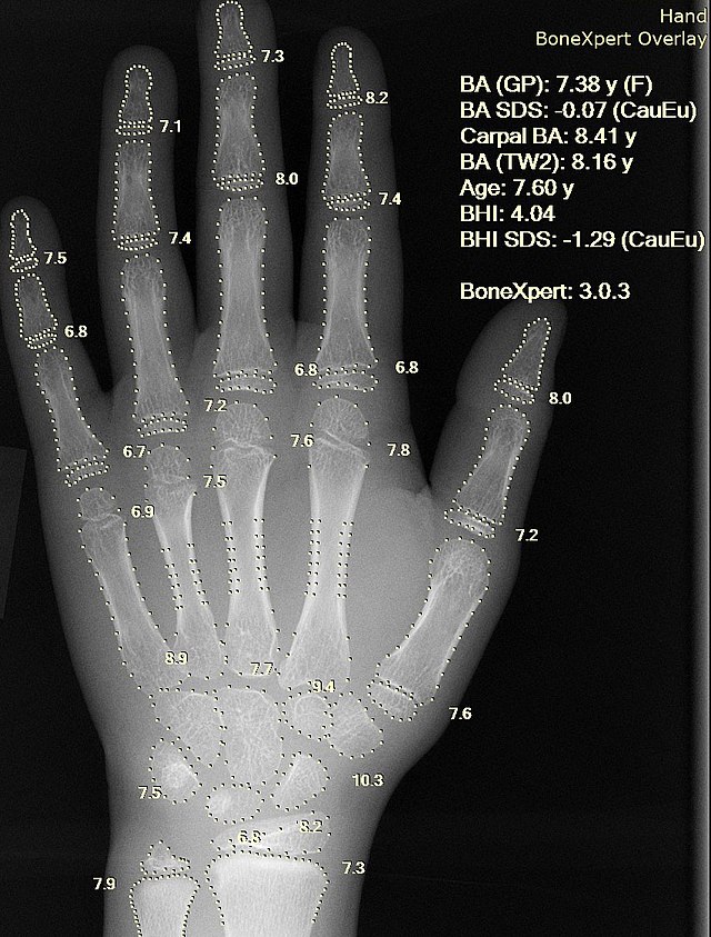 Bone age assessment X-ray with BoneXpert overlay