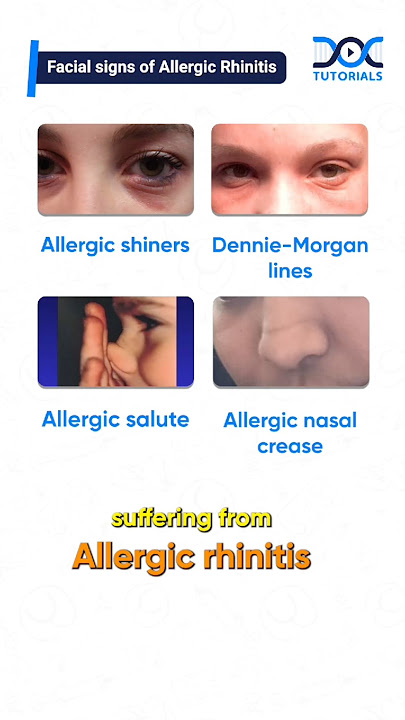 Allergic Rhinitis Clinical Signs