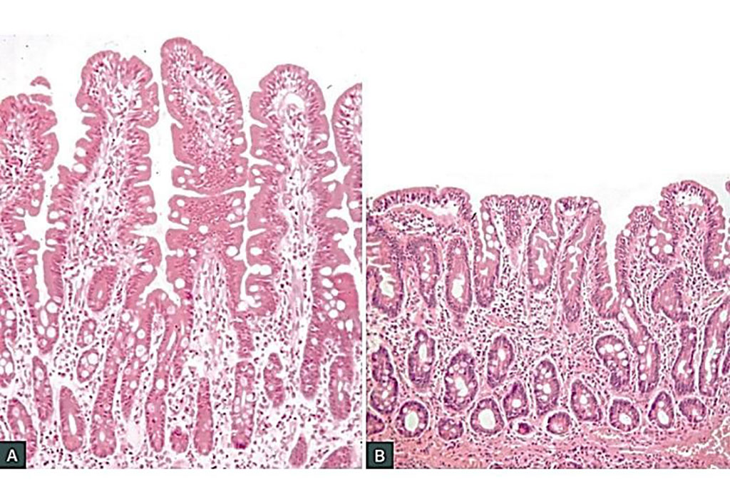 Comparison of normal small intestinal mucosa (A) and villous atrophy with crypt hyperplasia (B)