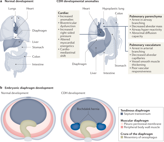 Congenital Diaphragmatic Hernia | Pediatric Surgery Basics - OnCourse ...