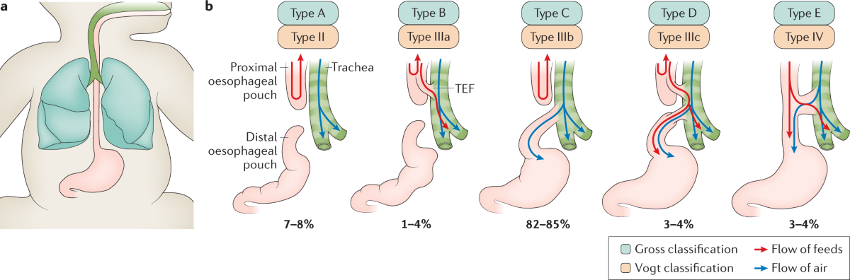 Tef Classification Esophageal Atresia and Tracheoesophageal Fistula | Pediatric Surgery ...