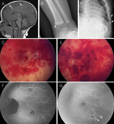 Battered Baby Syndrome signs: MRI showing subarachnoid hemorrhage, X-ray showing healing rib and metaphyseal fractures, and fundoscopy showing retinal hemorrhages.