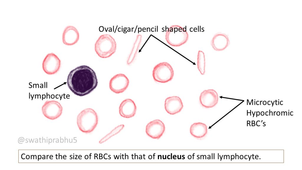 Microcytic hypochromic blood film showing pencil cells
