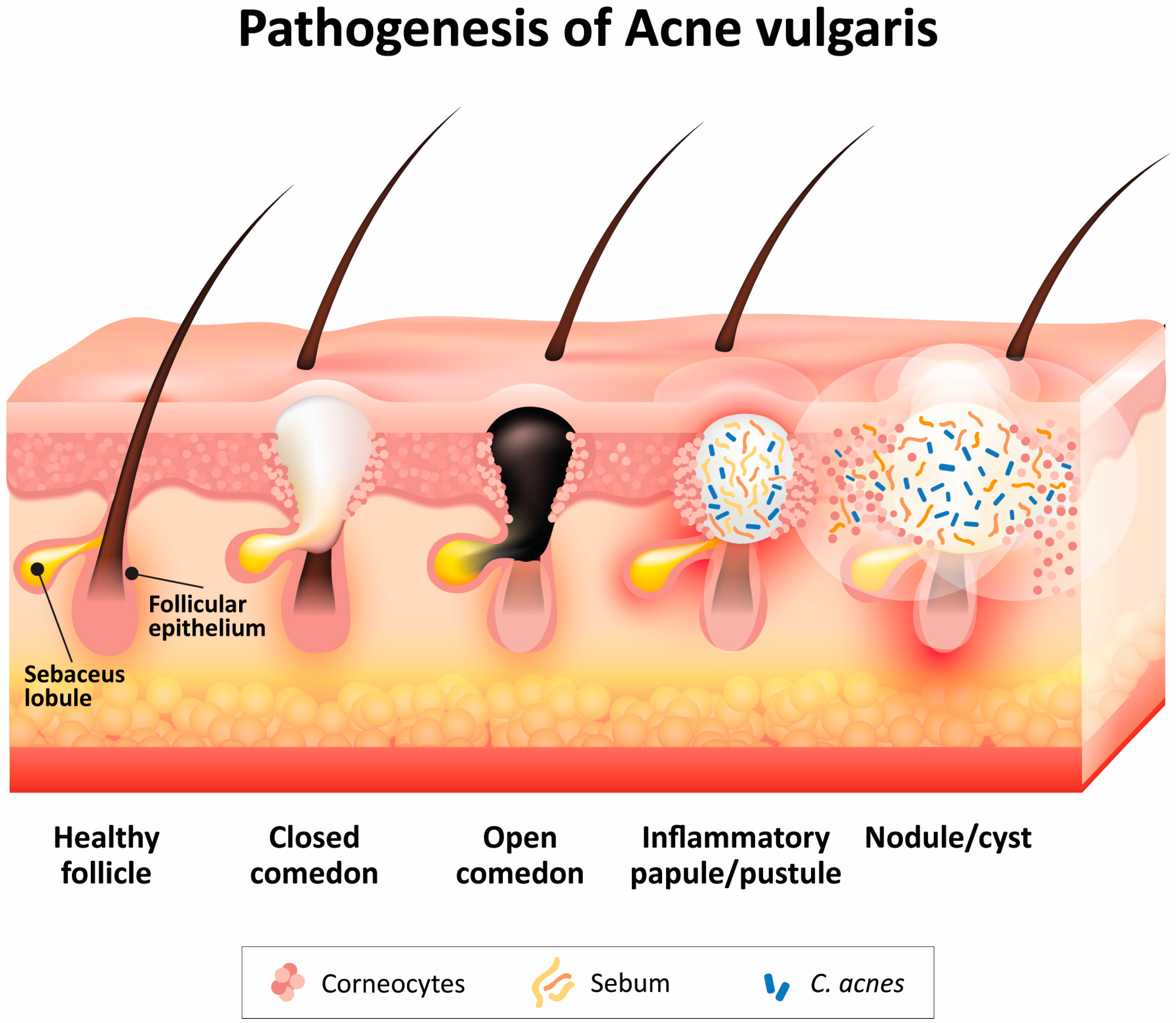 Pathogenesis of Acne Vulgaris