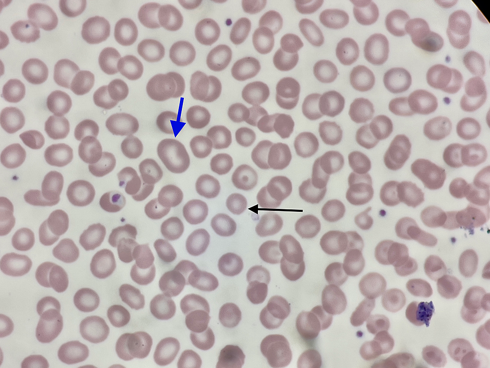 Peripheral blood smear: microcytic, normocytic, macrocytic