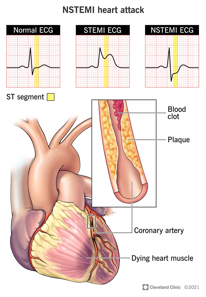 ECG and heart changes in STEMI vs NSTEMI heart attack