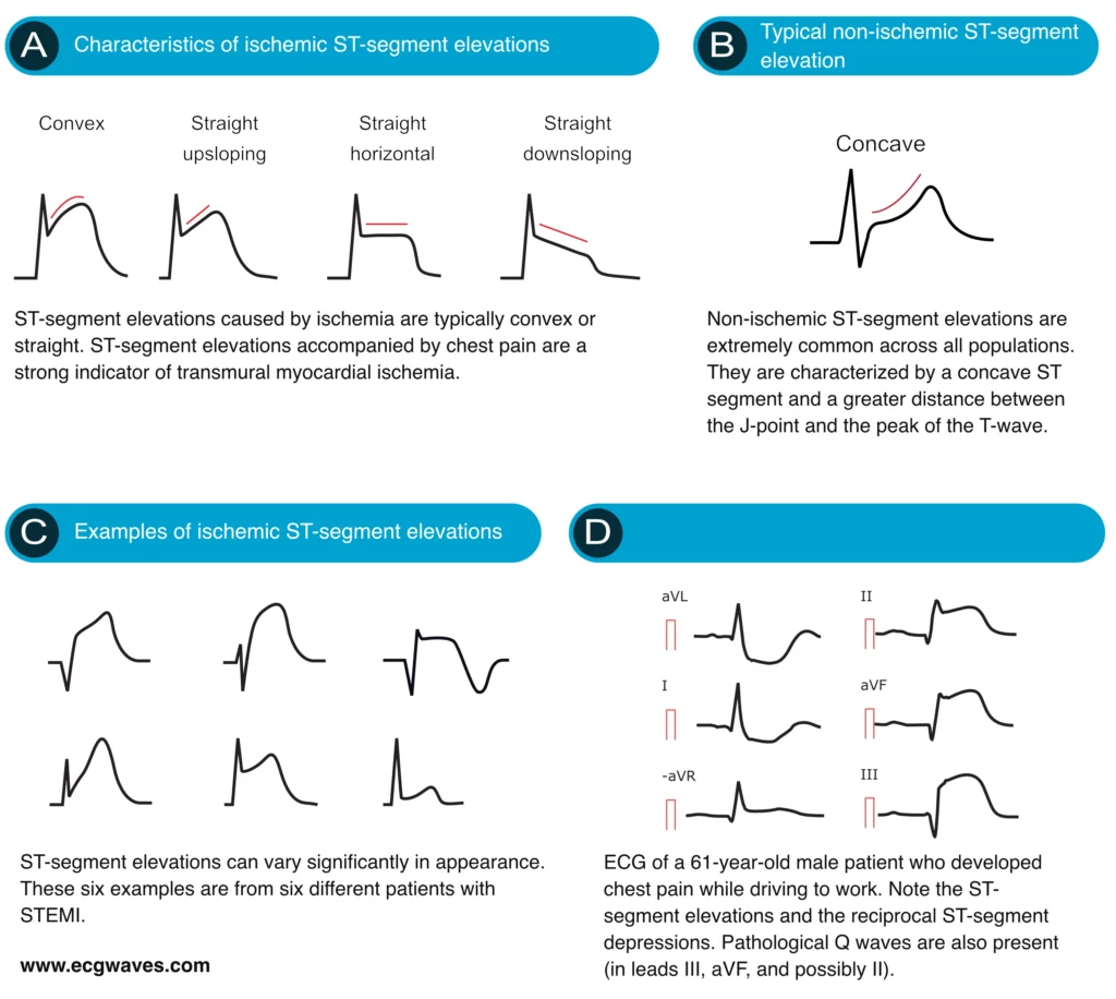 Ischemic vs. Non-Ischemic ST-Segment Elevation & Examples