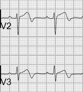 ECG showing significant ST segment elevation in leads V2 and V3, indicating an acute anterior myocardial infarction.