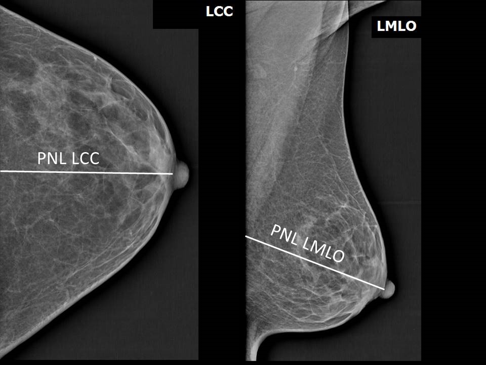 Standard Left Craniocaudal (LCC) and Left Mediolateral Oblique (LMLO) mammography views