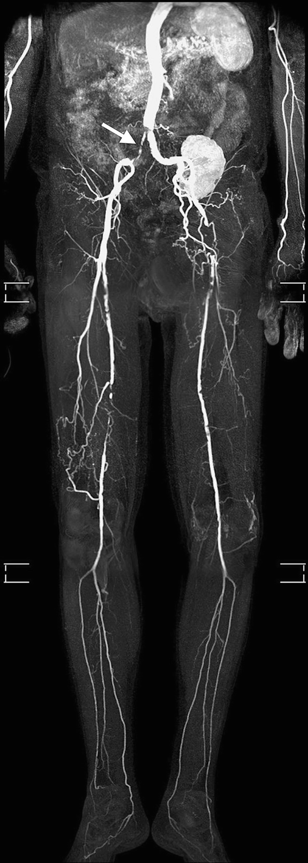 Peripheral Cta Peripheral Vascular Imaging | Cardiovascular Radiology - OnCourse NEET-PG