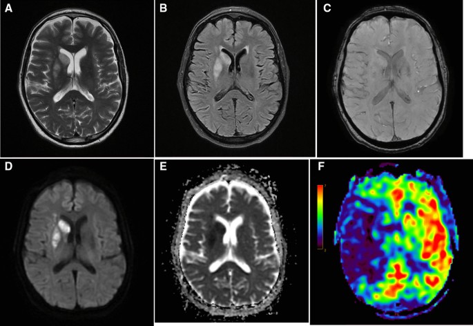 DWI PWI Mismatch in Acute Stroke