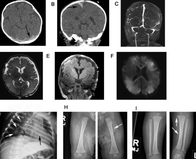 Child Abuse Imaging: Brain MRI, CT, Skeletal Survey