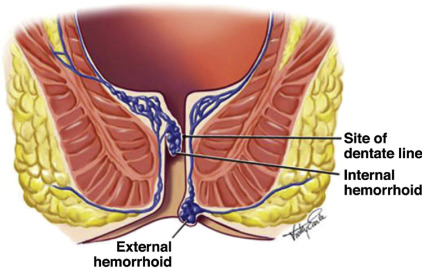 Anatomy of internal and external hemorrhoids