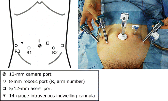 Robotic Surgery | Minimally Invasive Surgery - OnCourse NEET-PG