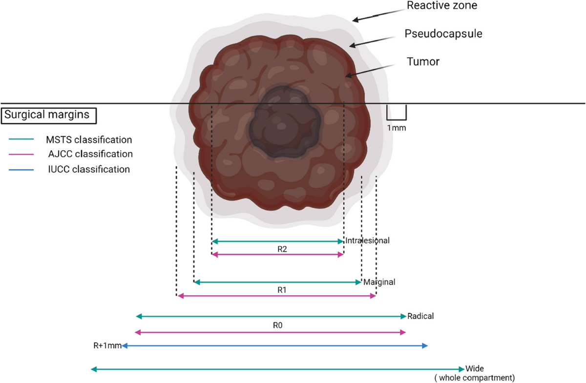 Radical R1 Principles of Cancer Therapy | Surgical Oncology Principles - OnCourse ...