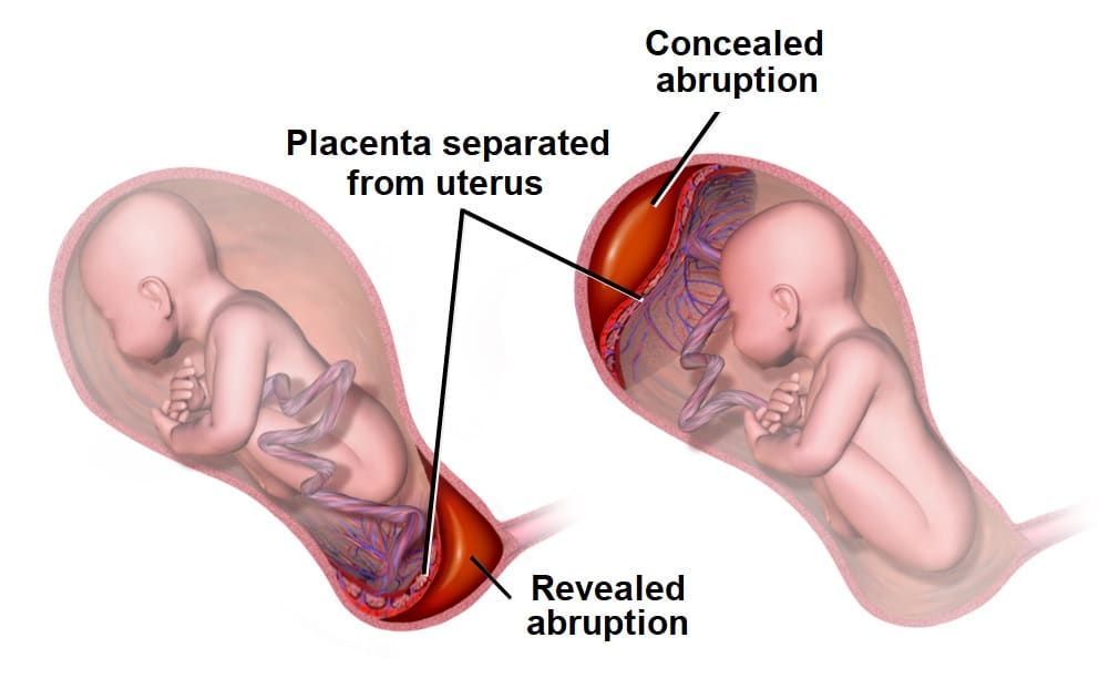 Placental Abruption: Revealed vs Concealed