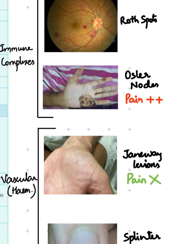 Clinical signs of Infective Endocarditis: Roth spots, Osler nodes, Janeway lesions, and splinter hemorrhages
