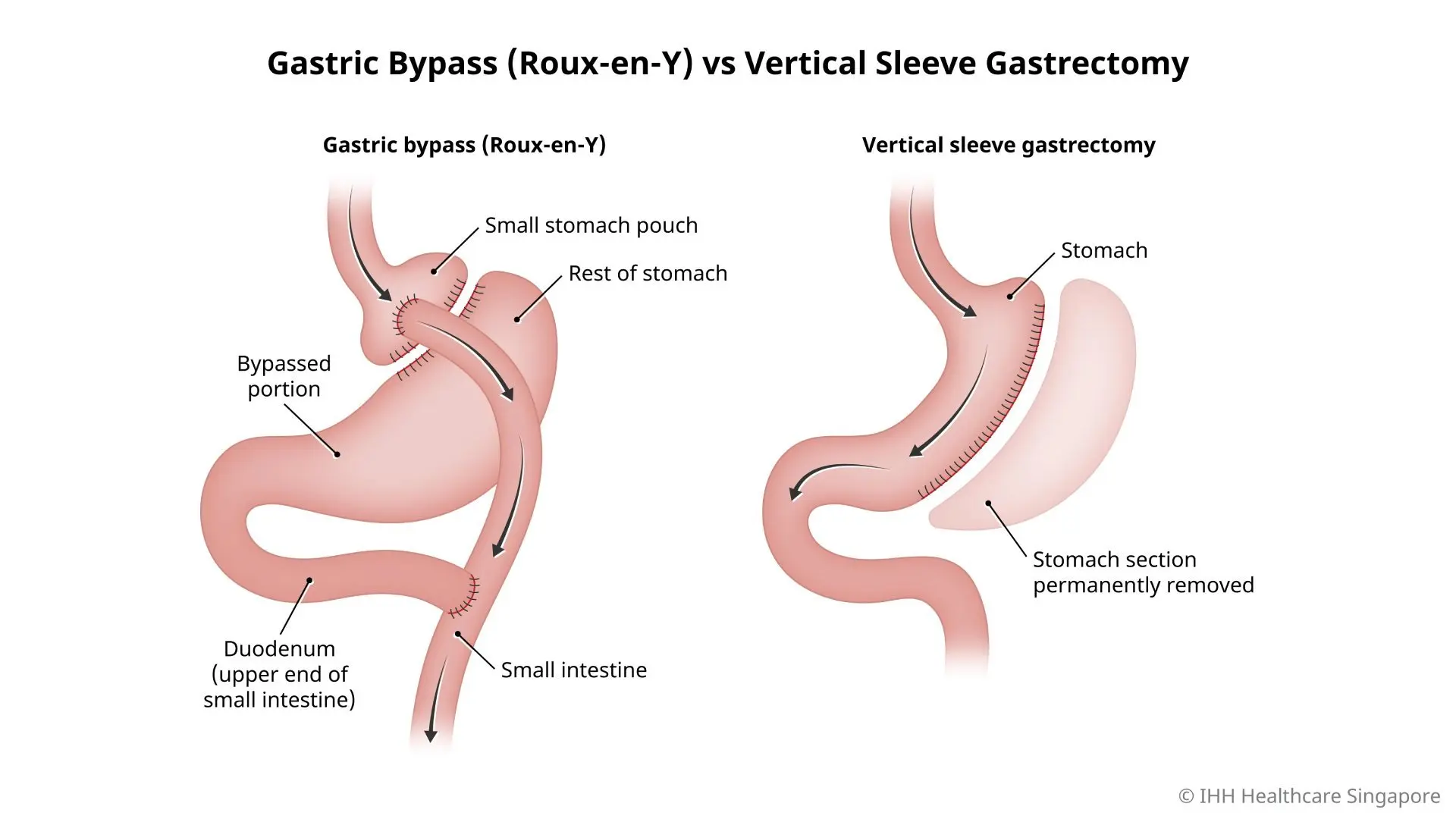 Comparison of Roux-en-Y Gastric Bypass and Vertical Sleeve Gastrectomy