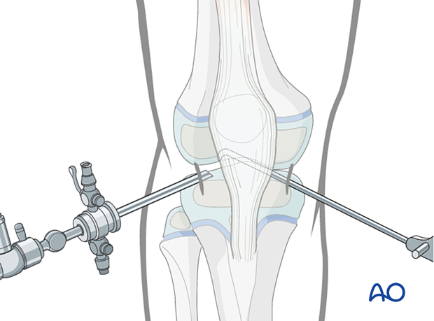 Knee Arthroscopy Portals