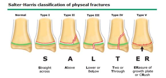 Salter-Harris classification of growth plate fractures
