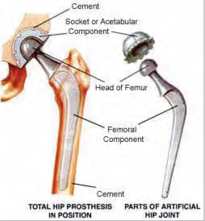 Total Hip Arthroplasty Components