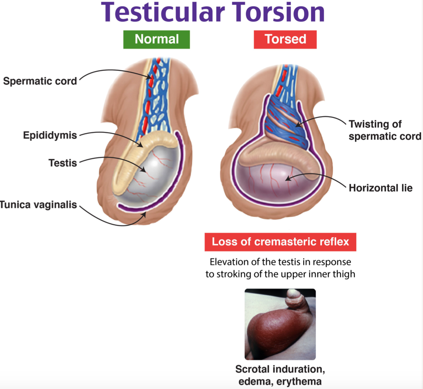 Diagram showing normal vs torsed testis and the bell clapper deformity