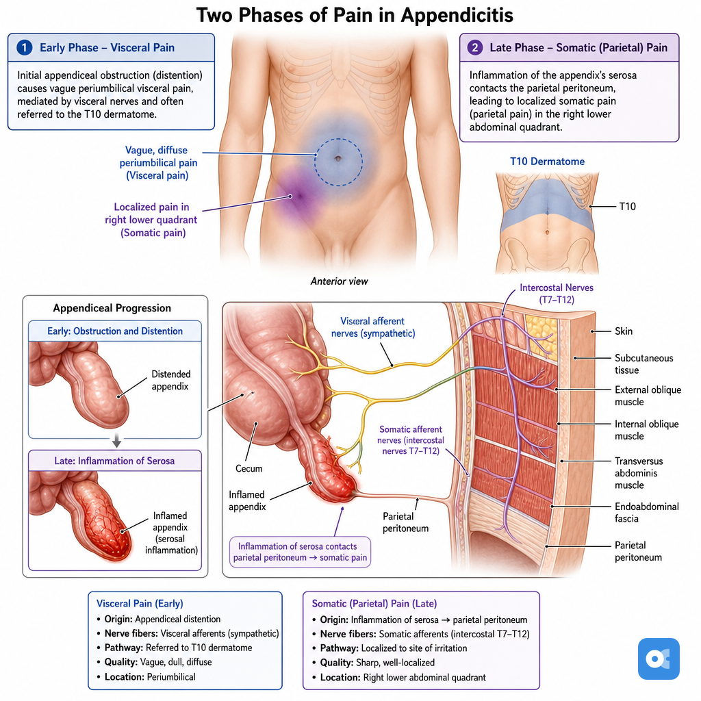 Appendicitis pain migration pattern from periumbilical to right lower quadrant
