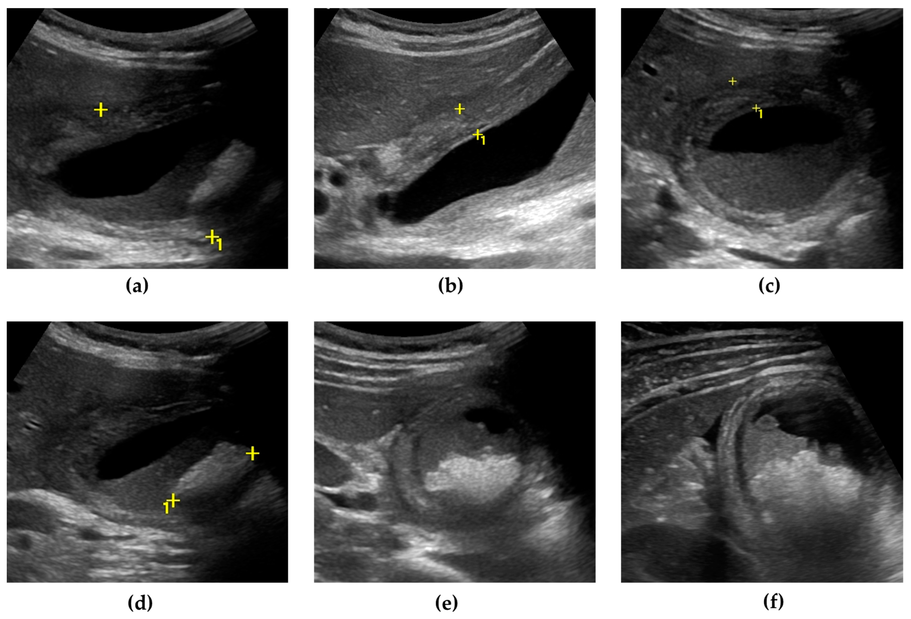 Ultrasound examination showing gallbladder wall thickening in cholecystitis