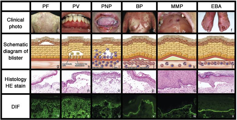 Histopathology comparison of blistering diseases