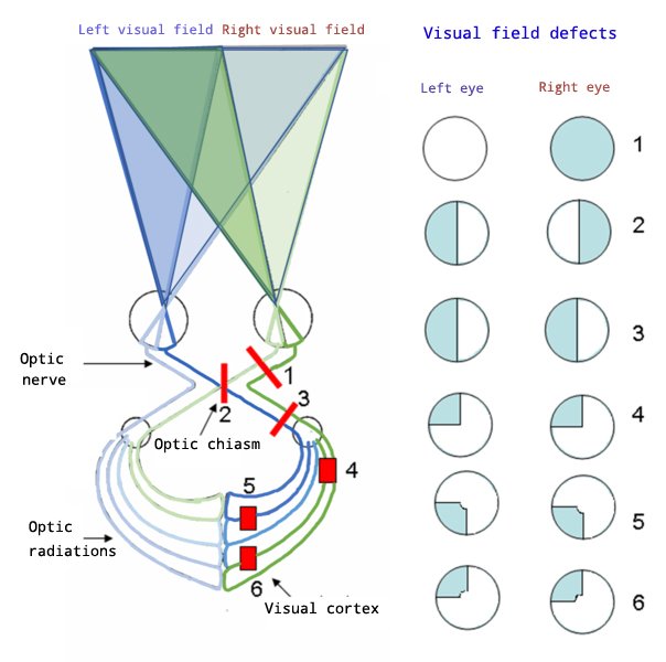 Visual field defects diagram showing different patterns