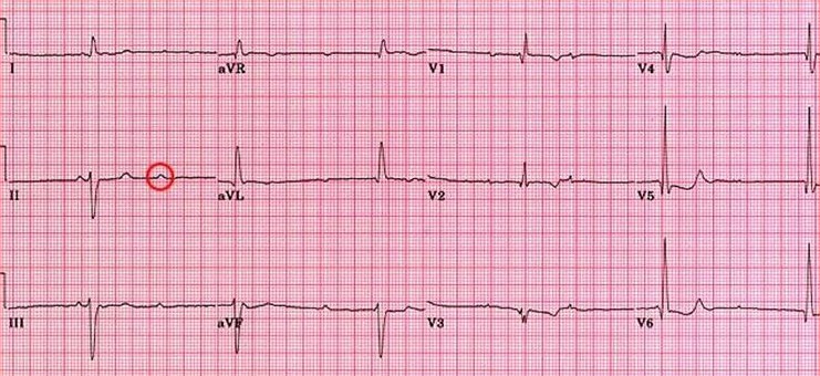 Atrial Fibrillation ECG