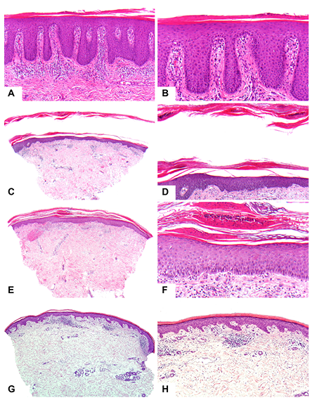 Histopathology patterns of skin biopsy