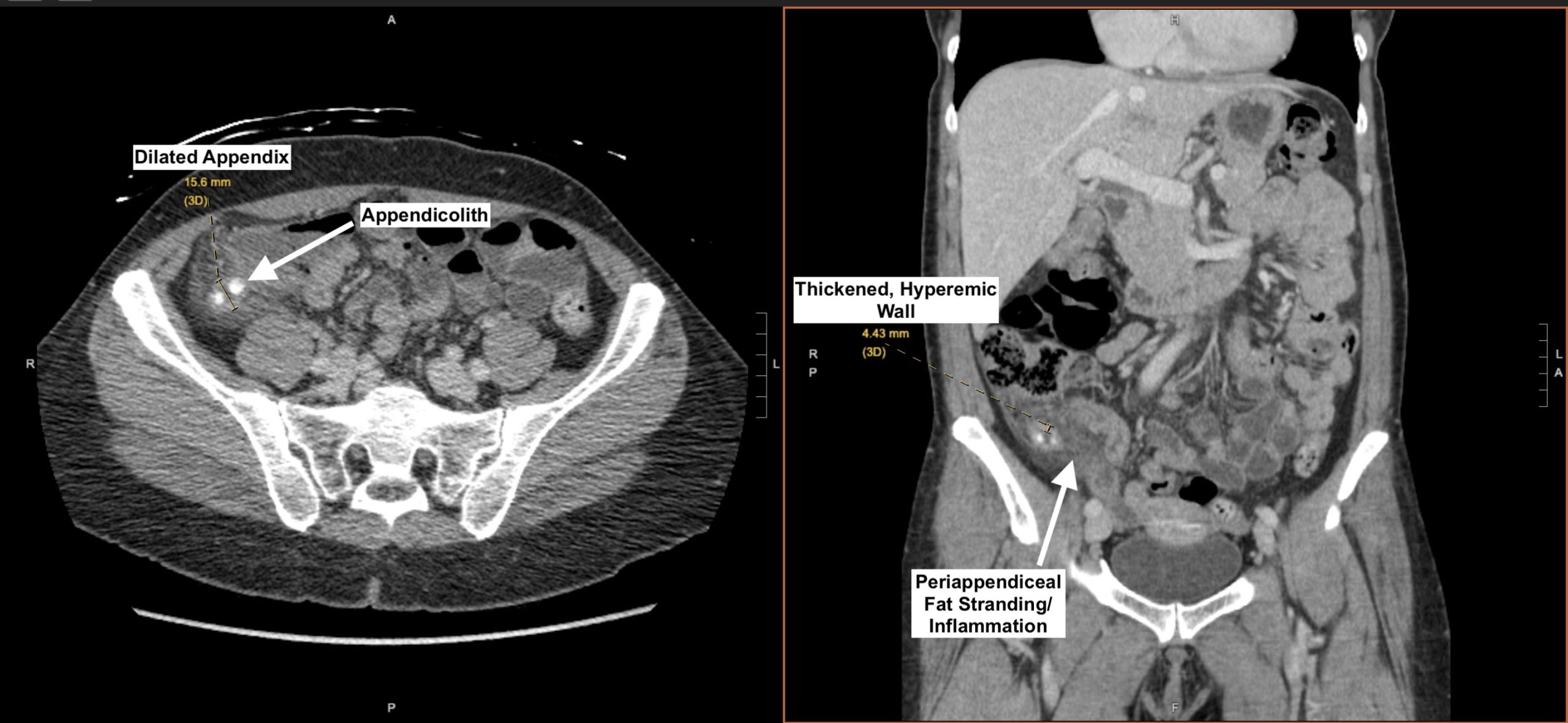 CT scan showing acute appendicitis with appendicolith and periappendiceal fat stranding
