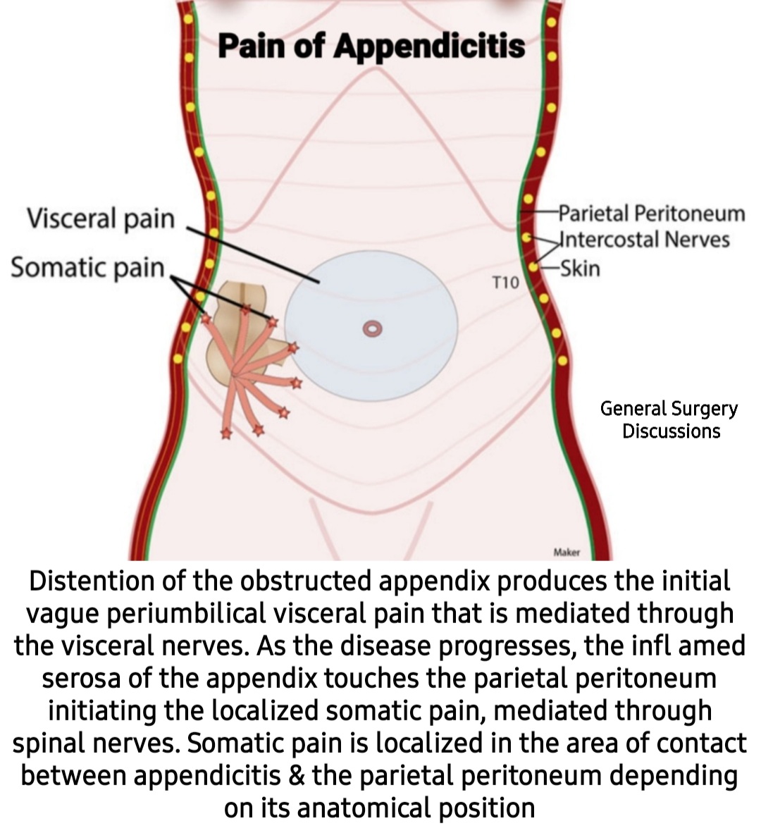 Appendicitis pain migration pattern from periumbilical to right lower quadrant