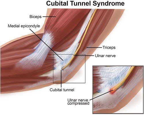 Anatomical diagram comparing nerve compression sites and symptoms