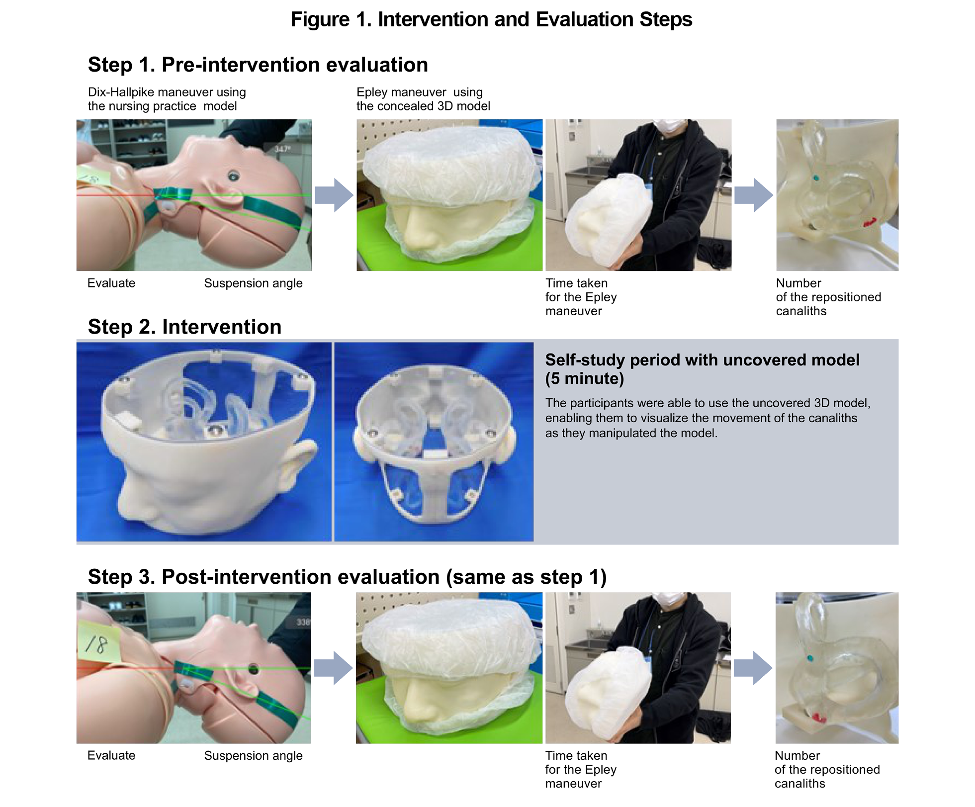 Diagram showing Epley maneuver steps for posterior canal BPPV treatment