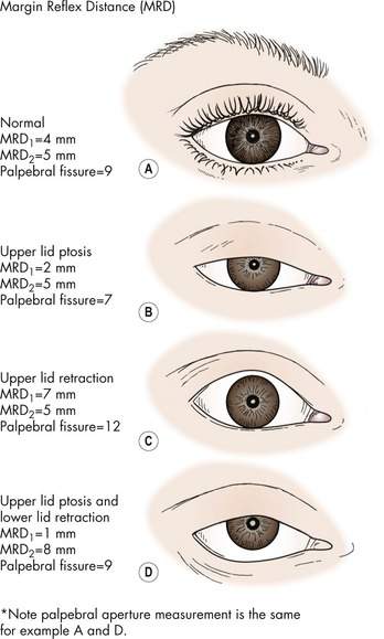 Standardized measurement tools and techniques for oculoplastic assessment