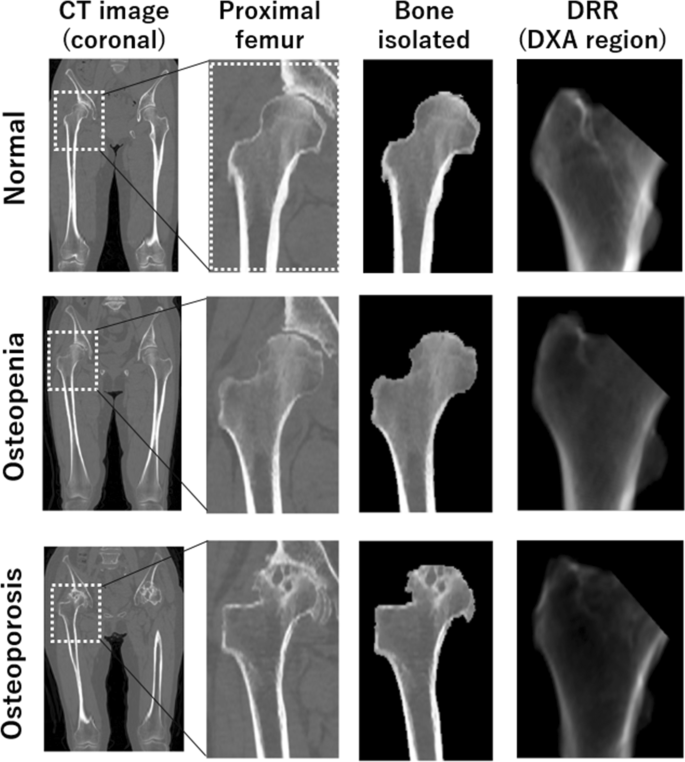 Bone quality assessment methods including DEXA and CT analysis