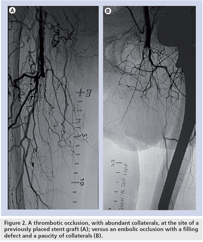 Angiographic comparison of embolic versus thrombotic arterial occlusion