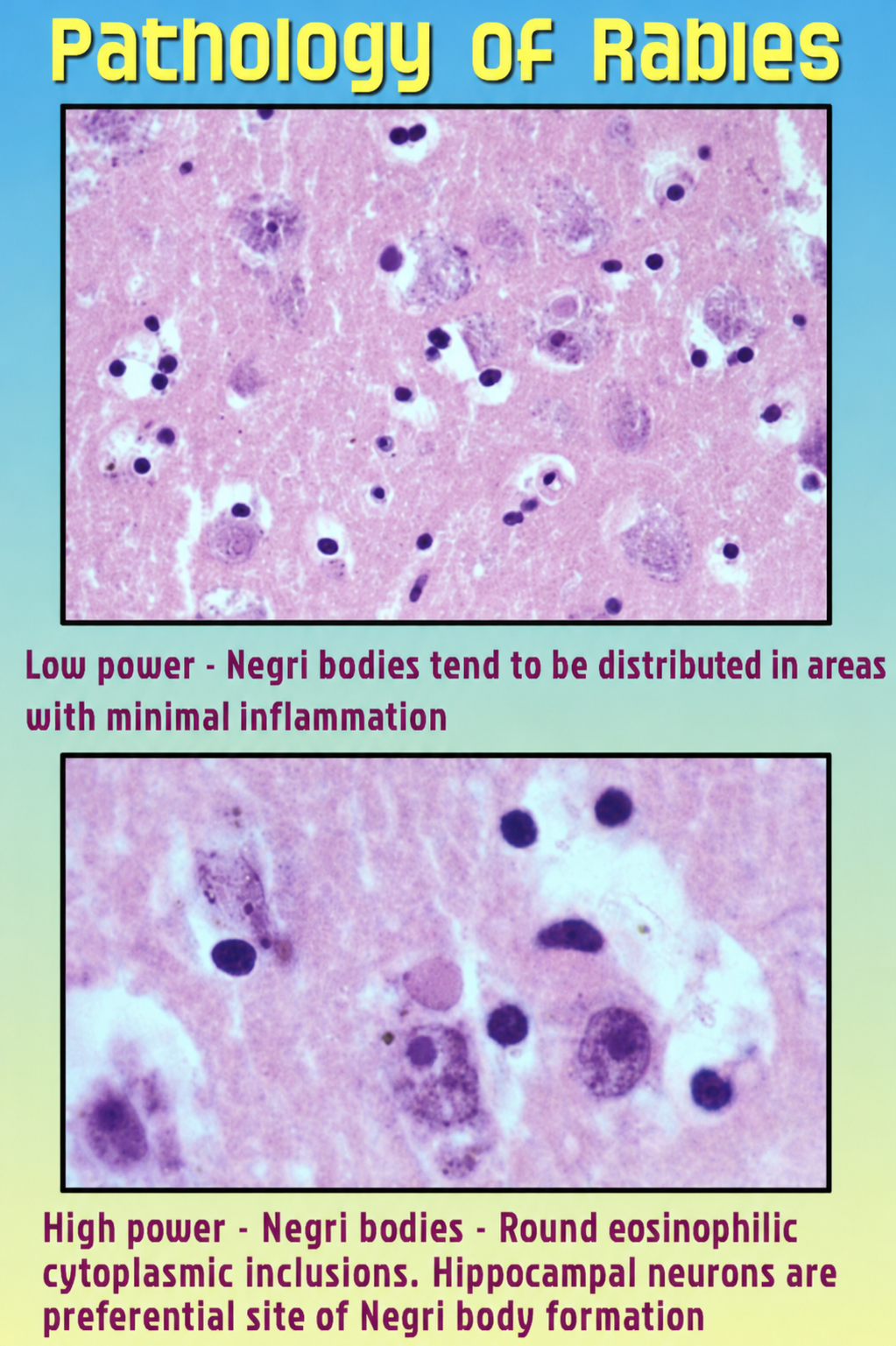 Rabies: Negri bodies in hippocampus neurons