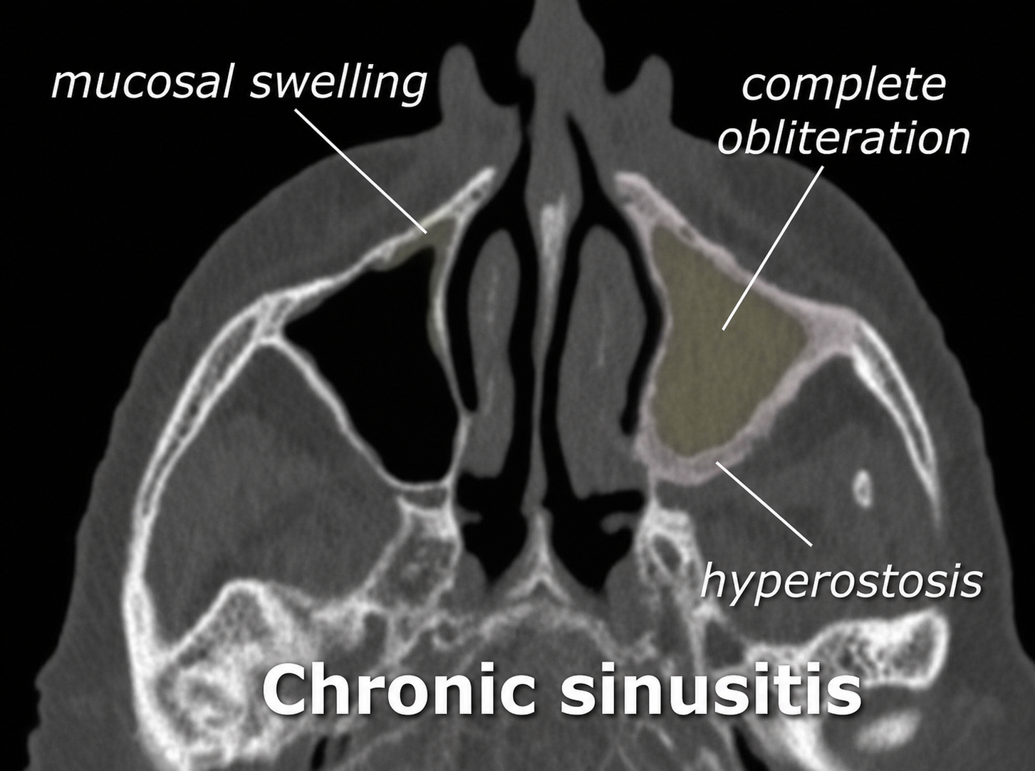 CT scan showing chronic rhinosinusitis