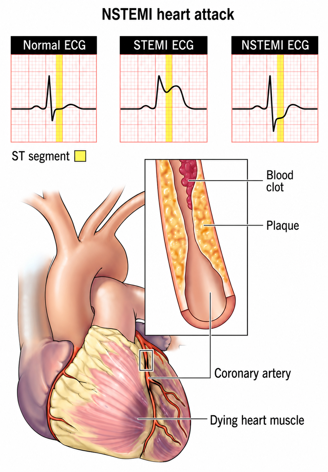 ECG and heart changes in STEMI vs NSTEMI heart attack