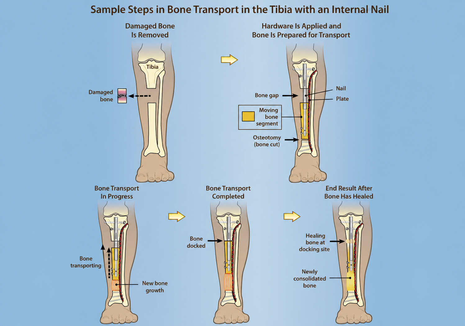 Bone Transport in Tibia with Internal Nail
